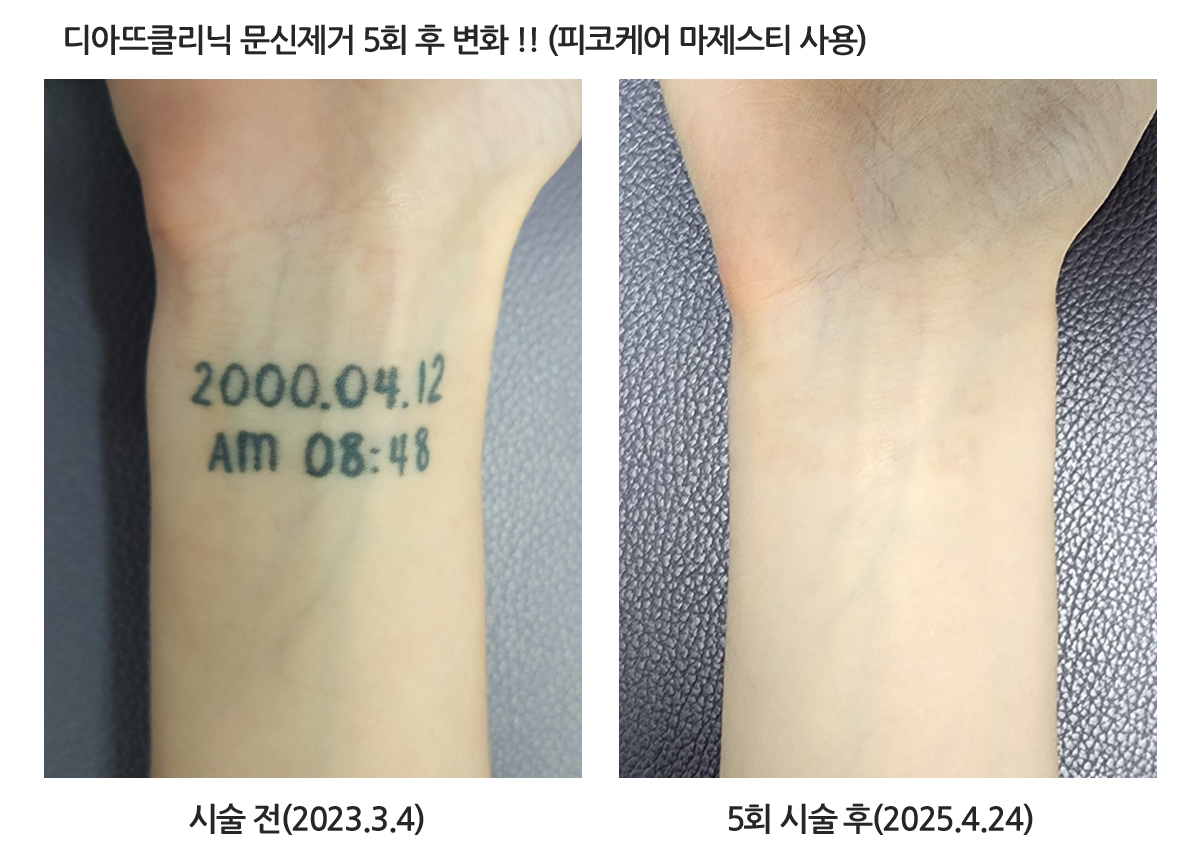 피코케어 마제스티 상세 안내 이미지 2